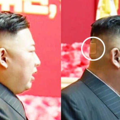 Băng dán đầu bí ẩn làm dấy lên những đồn đoán về sức khỏe ông Kim Jong Un