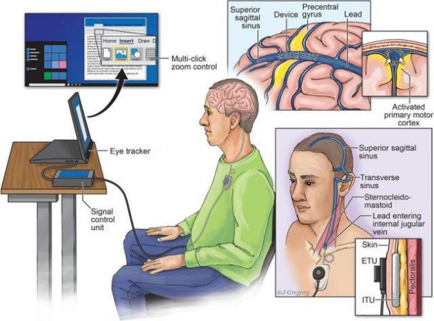 Không phải Neuralink của Elon Musk, đây mới là công ty dẫn đầu thế giới về công nghệ cấy chip vào não người - Ảnh 2.