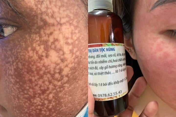 Mua mỹ phẩm trên mạng làm đẹp cấp tốc, nhiều người mất Tết vì biến chứng - Ảnh 1