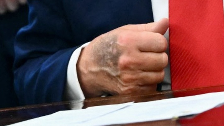 Bàn tay thâm tím của ông Trump gây chú ý - Ảnh 1