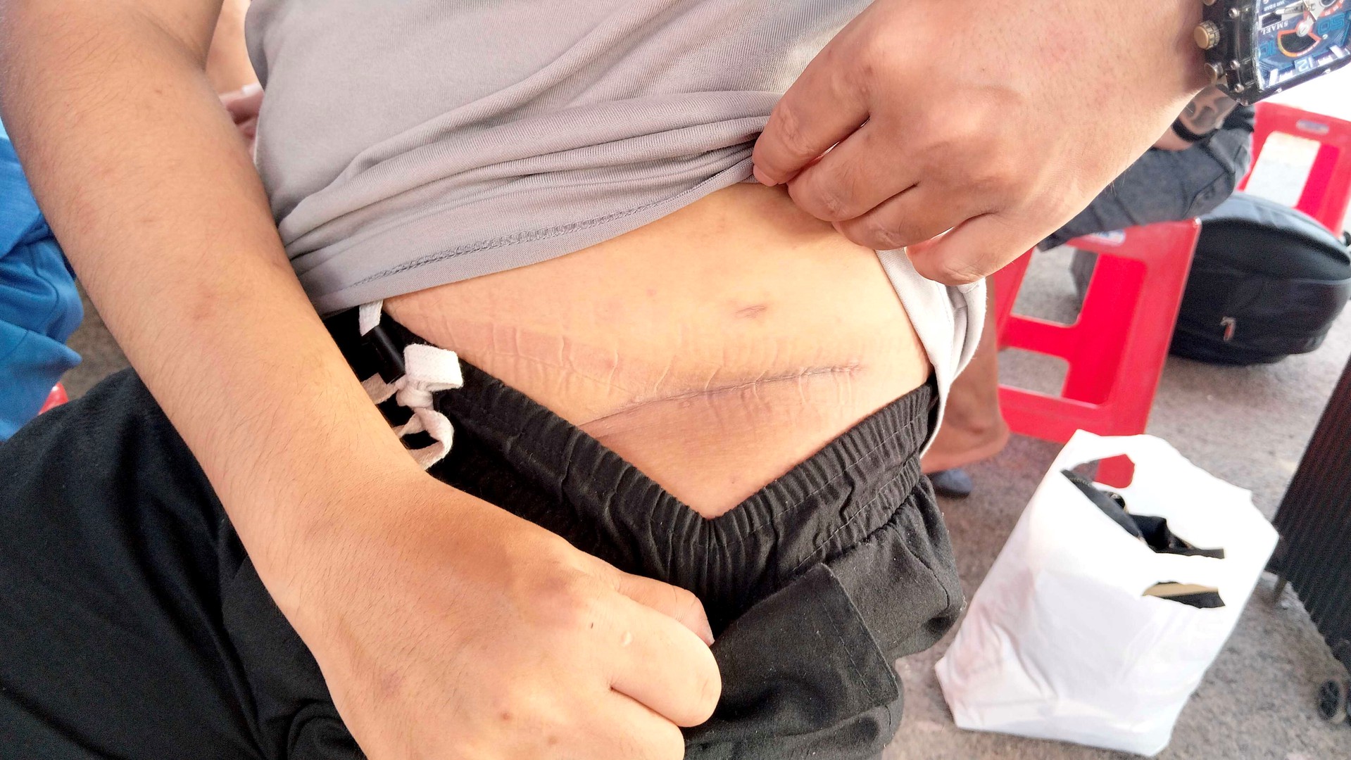 Nam thanh niên sang Campuchia làm “việc nhẹ lương cao” bị cưỡng ép cắt bỏ một quả thận: Vết sẹo dài bên mạn sườn gây ám ảnh - Ảnh 2