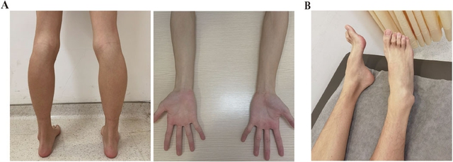 Gia tộc Samsung và căn bệnh di truyền đáng sợ mang tên teo cơ MÁC: Có tất cả nhưng cũng không thể chữa khỏi - Ảnh 7