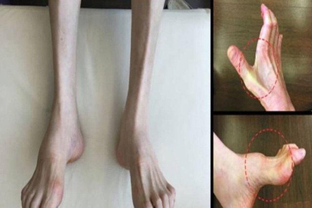 Gia tộc Samsung và căn bệnh di truyền đáng sợ mang tên teo cơ MÁC: Có tất cả nhưng cũng không thể chữa khỏi - Ảnh 4