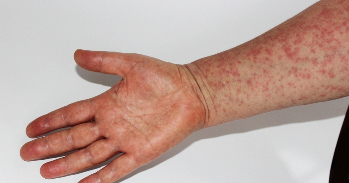 Dịch sởi lan rộng khiến hàng chục trẻ em tử vong, một quốc gia triển khai chiến dịch tiêm chủng khẩn cấp