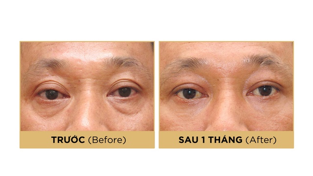 Đằng sau quyết định chỉnh mí là tầm nhìn lãnh đạo của nam doanh nhân - Ảnh 1