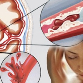Những điều cần biết về tai biến mạch máu não