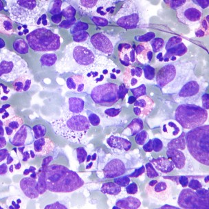 Tìm hiểu về căn bệnh ung thư hạch loại Lymphoma Hodgkin's