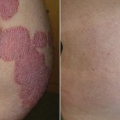 Tinh dầu thực vật góp phần phục hồi tế bào bệnh vảy nến